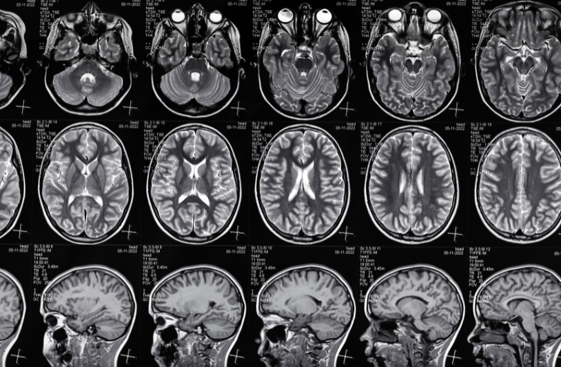traumatic brain injuries scans